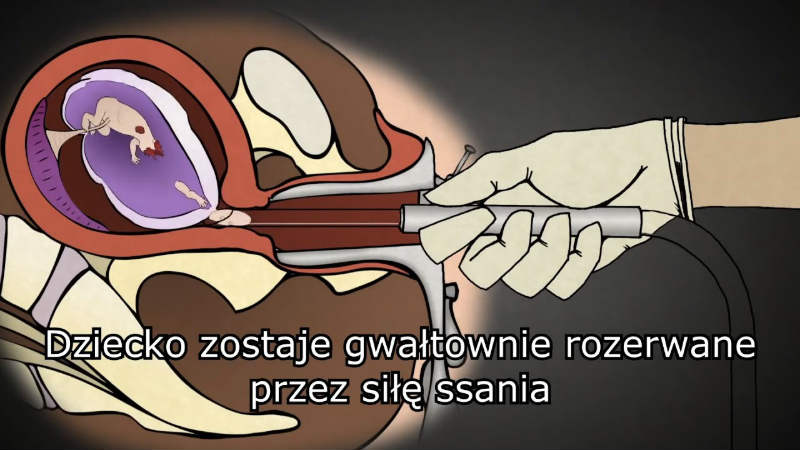[SZOKUJĄCE DANE!] Aborcja w zaawansowanej ciąży i zabijanie po narodzinach – tak wygląda światowy trend!